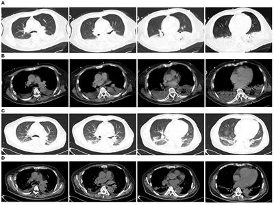 Metagenomic next-generation sequencing confirms the diagnosis of Legionella pneumonia with rhabdomyolysis and acute kidney injury in a limited resource area: a case report and review